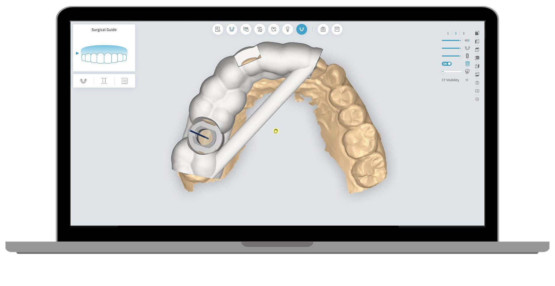 AI-implant-surgical-guide-design-16 AI Implant Surgical Guide Design