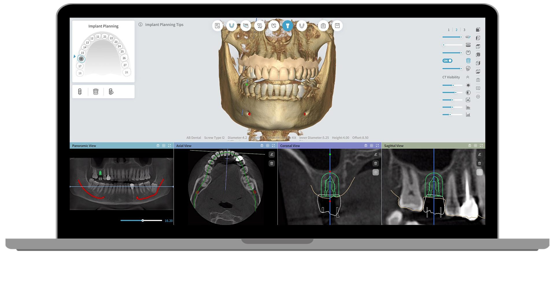 AI-implant-surgical-guide-software-example 17 AI Implant Surgical Guide Design 2