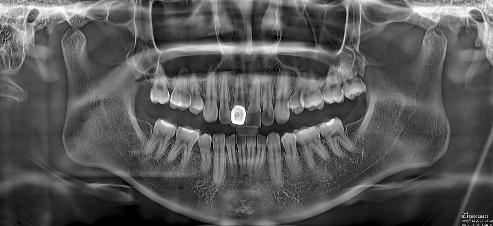 CBCT-image_9