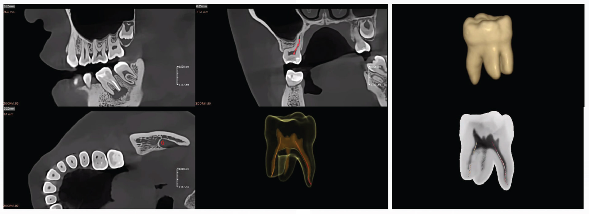 Example-image-AI-crown-design 18 Fussen_AI crown design and chairside workflow
