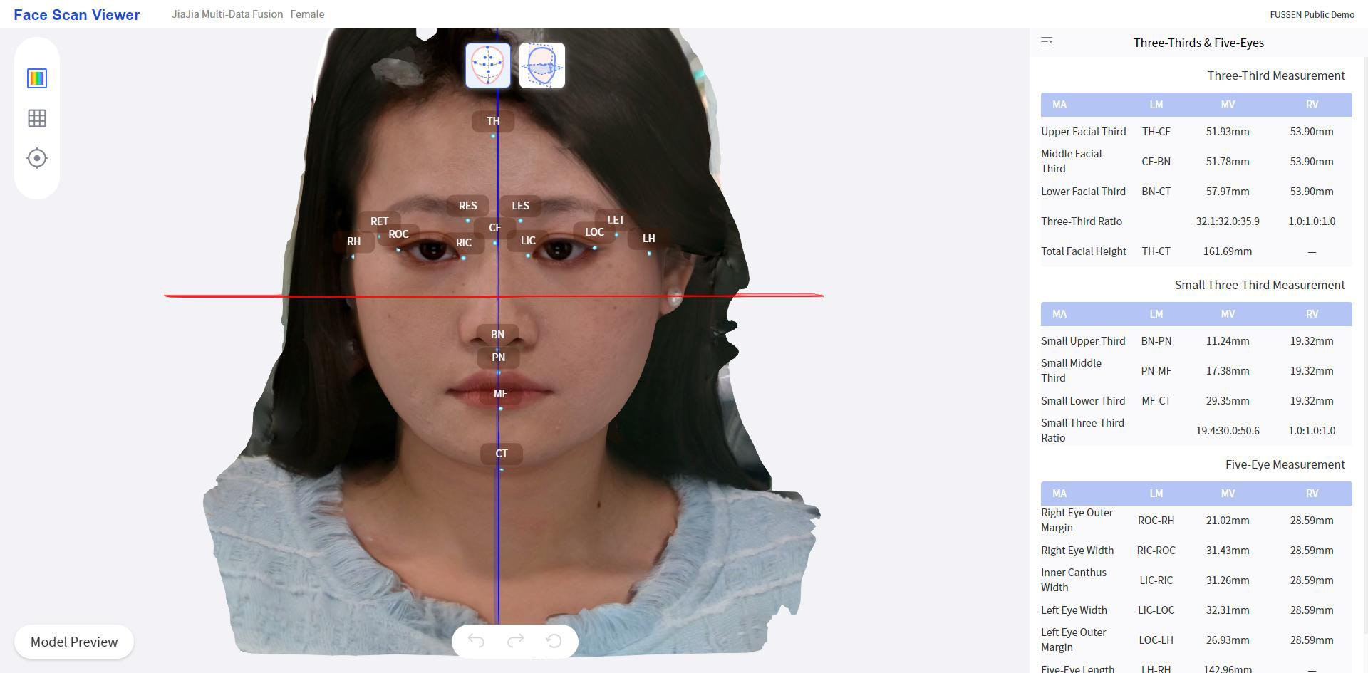 Facescan-fusion-and-3D-digital-smile-design_22 Fussen Rubik X CBCT Face Scan and 3D Digital Smile Design 1