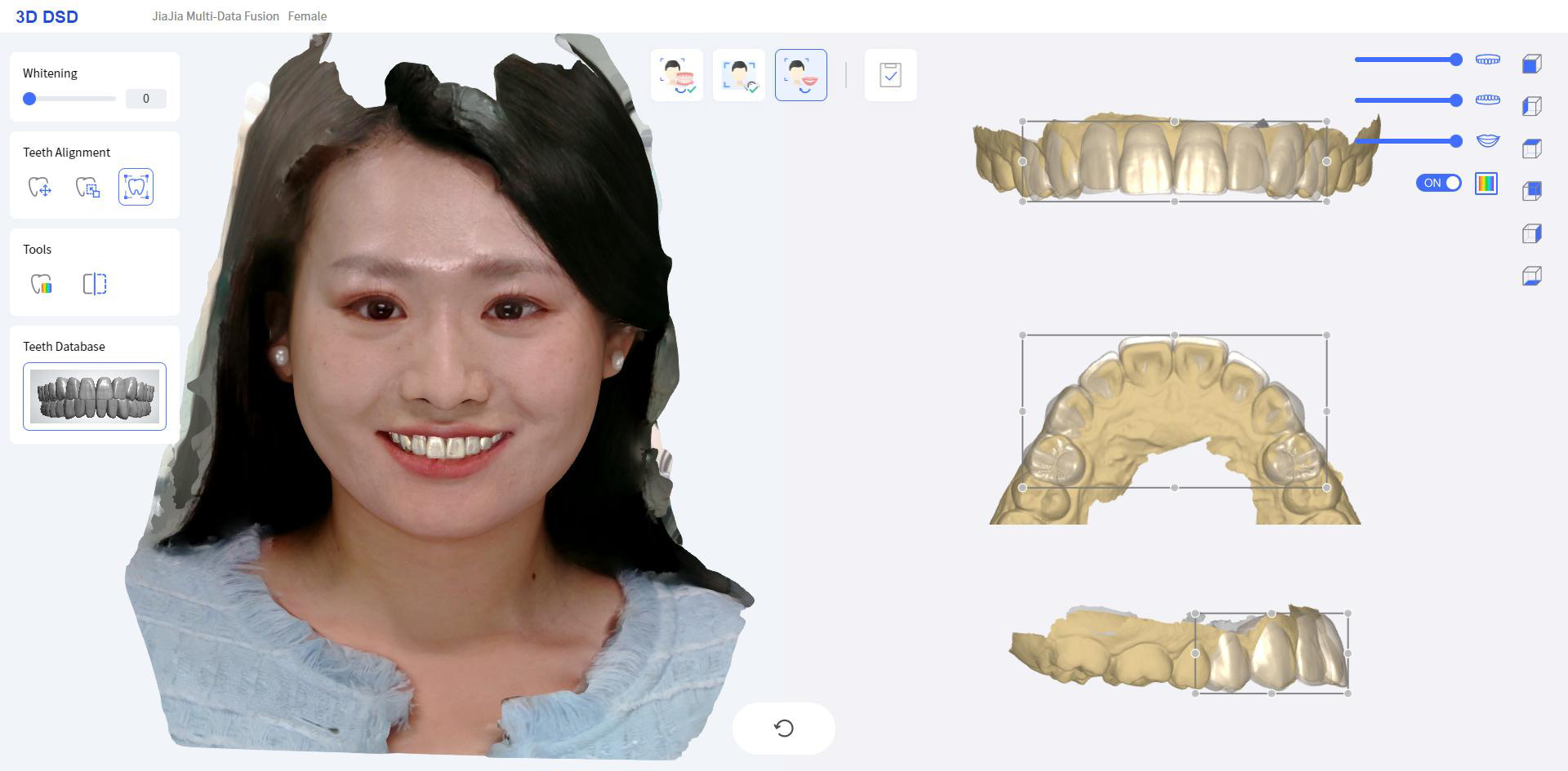 Facescan-fusion-and-3D-digital-smile-design_23 Fussen Rubik X CBCT Face Scan and 3D Digital Smile Design 2