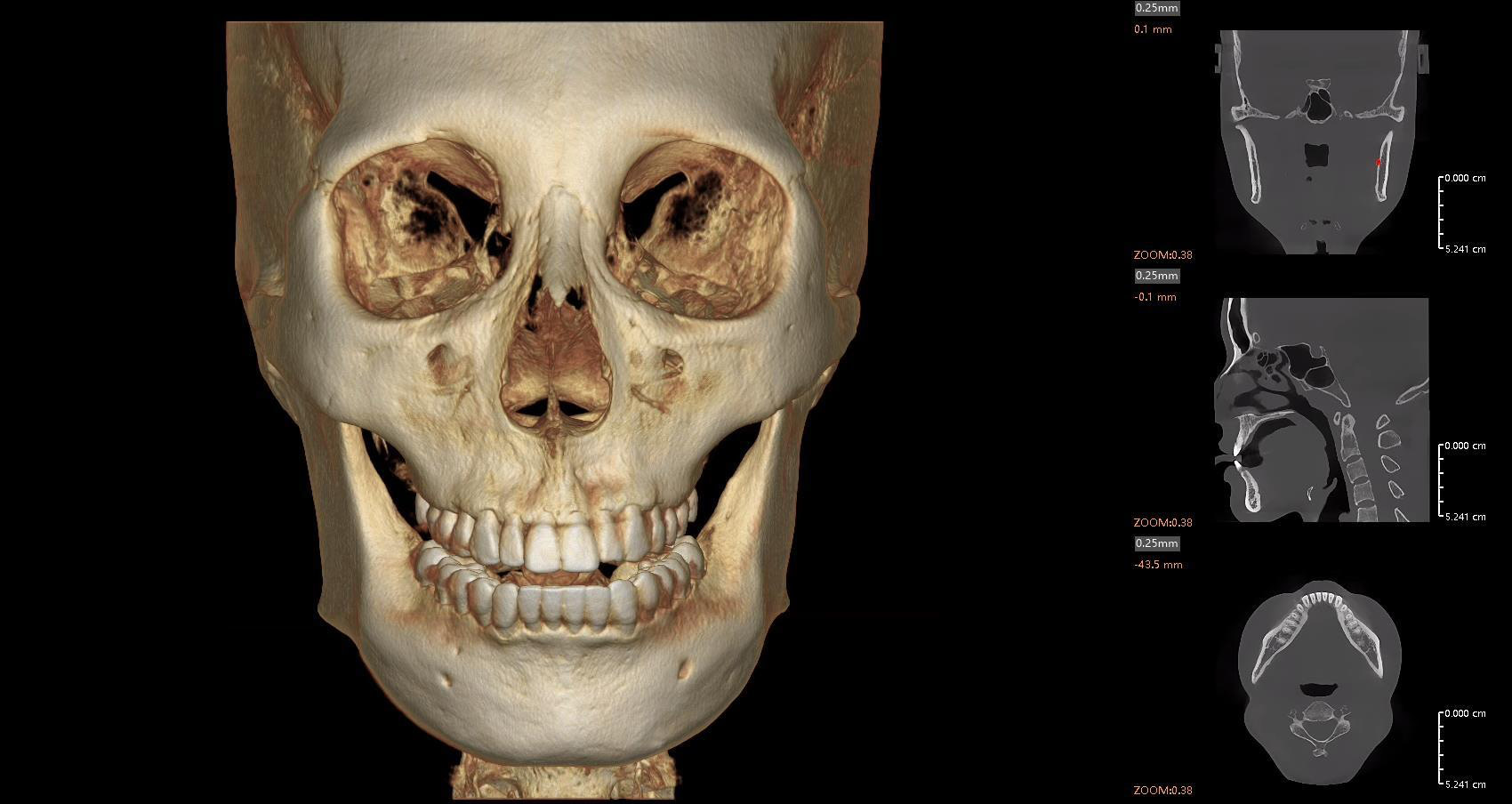 TMJ-segmentation-and-analysis_25 TMJ segmentation and analysis with distance and density measurement tools 1
