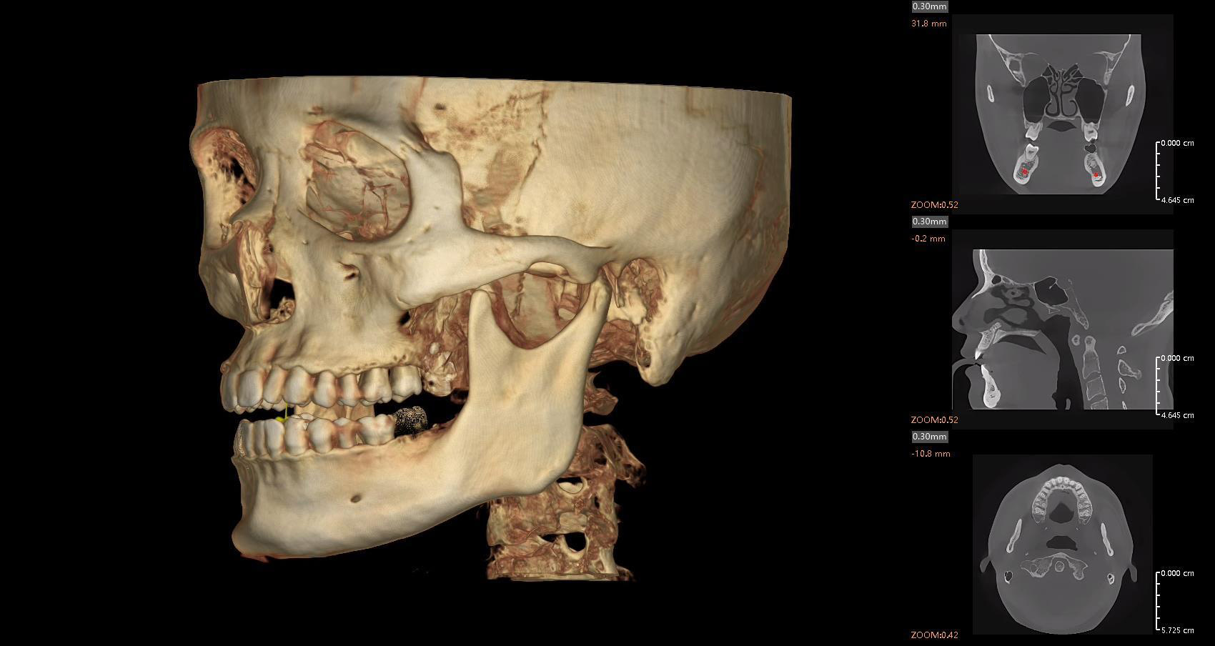 TMJ-segmentation-and-analysis_26 TMJ segmentation and analysis with distance and density measurement tools 2