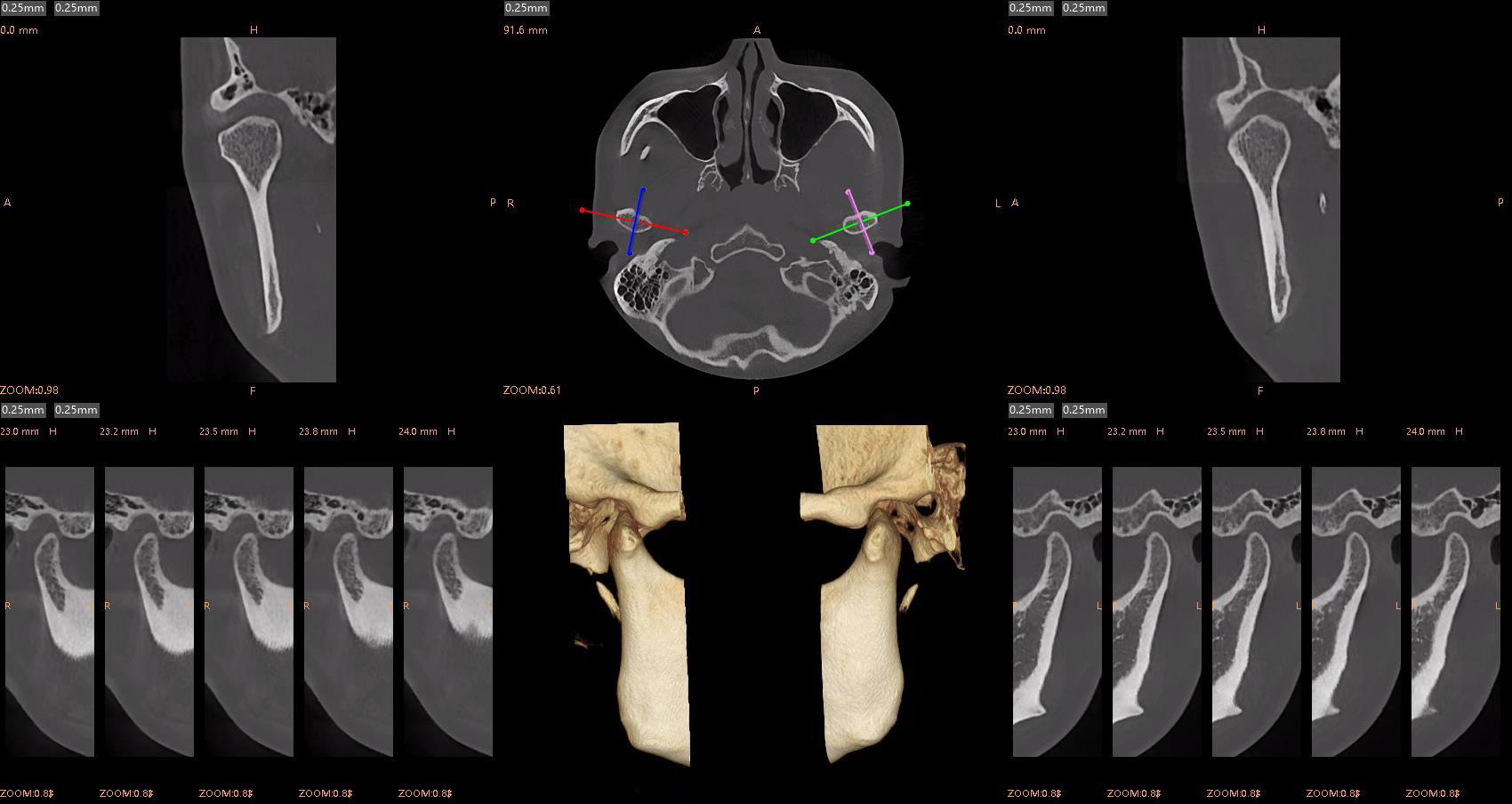 TMJ-segmentation-and-analysis__27 TMJ-segmentation-and-analysis
