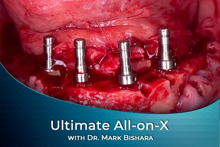 ULTIMATE ALL ON X COURSE
