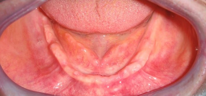 edentulous ridge