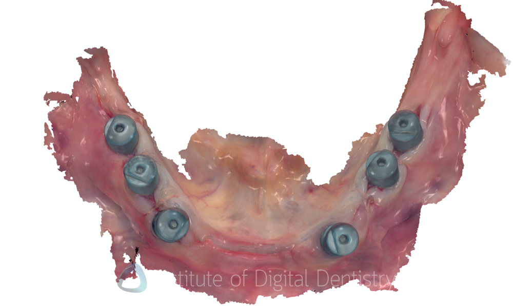 edentulous scanning digital dentistry TRIOS 3Shape (1)