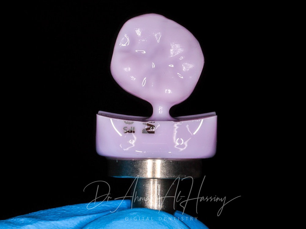 3D_printing_midas_veneers_vs_emax1