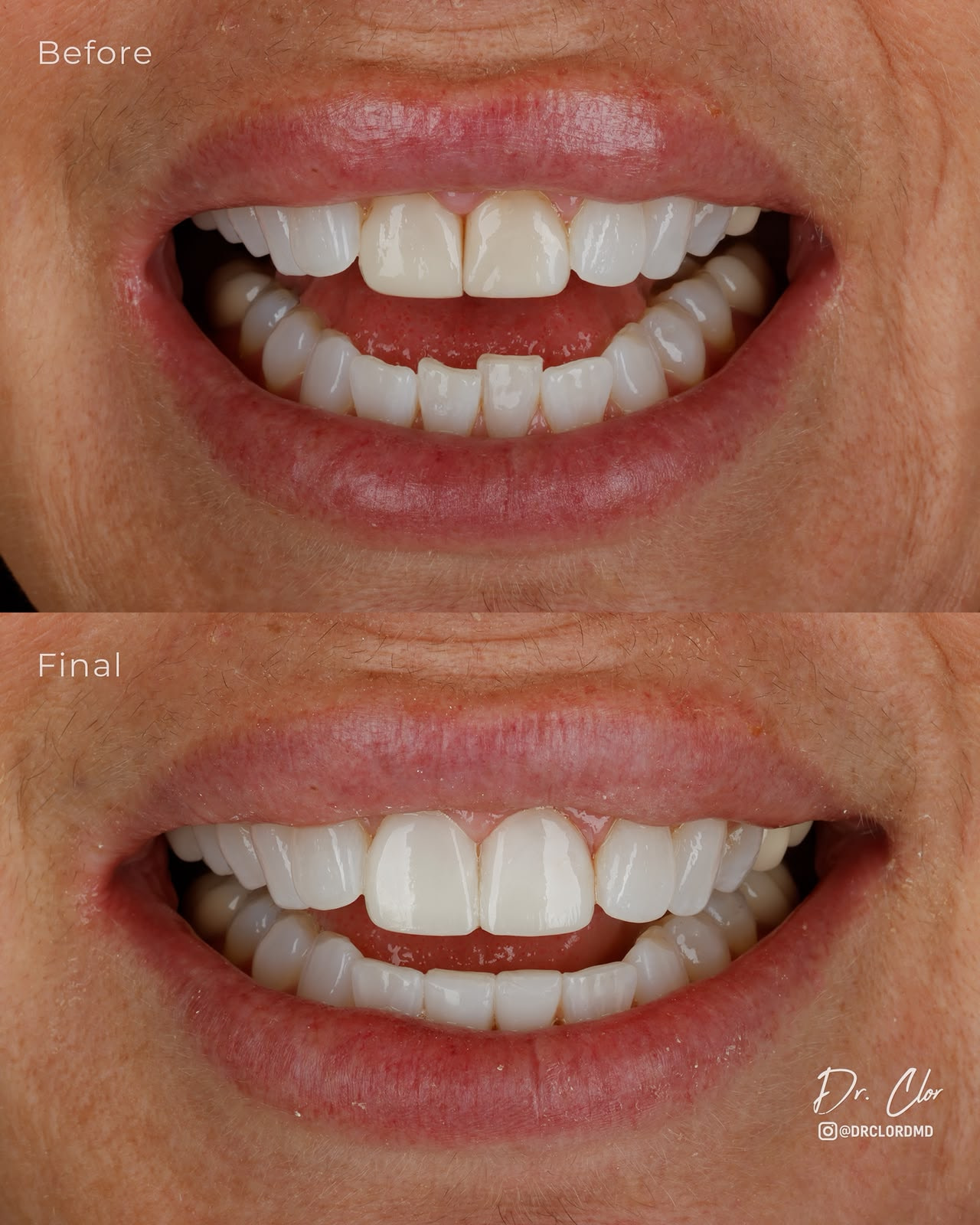 omar clor printed veneers 2