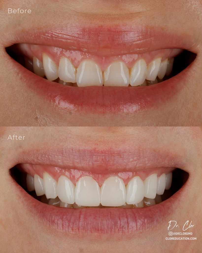 omar clor printed veneers