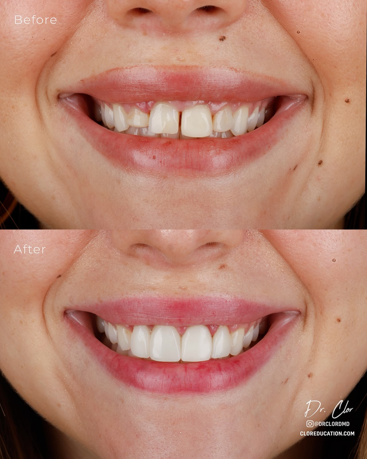 omar_clor_printed_restorations_dentistry (2)