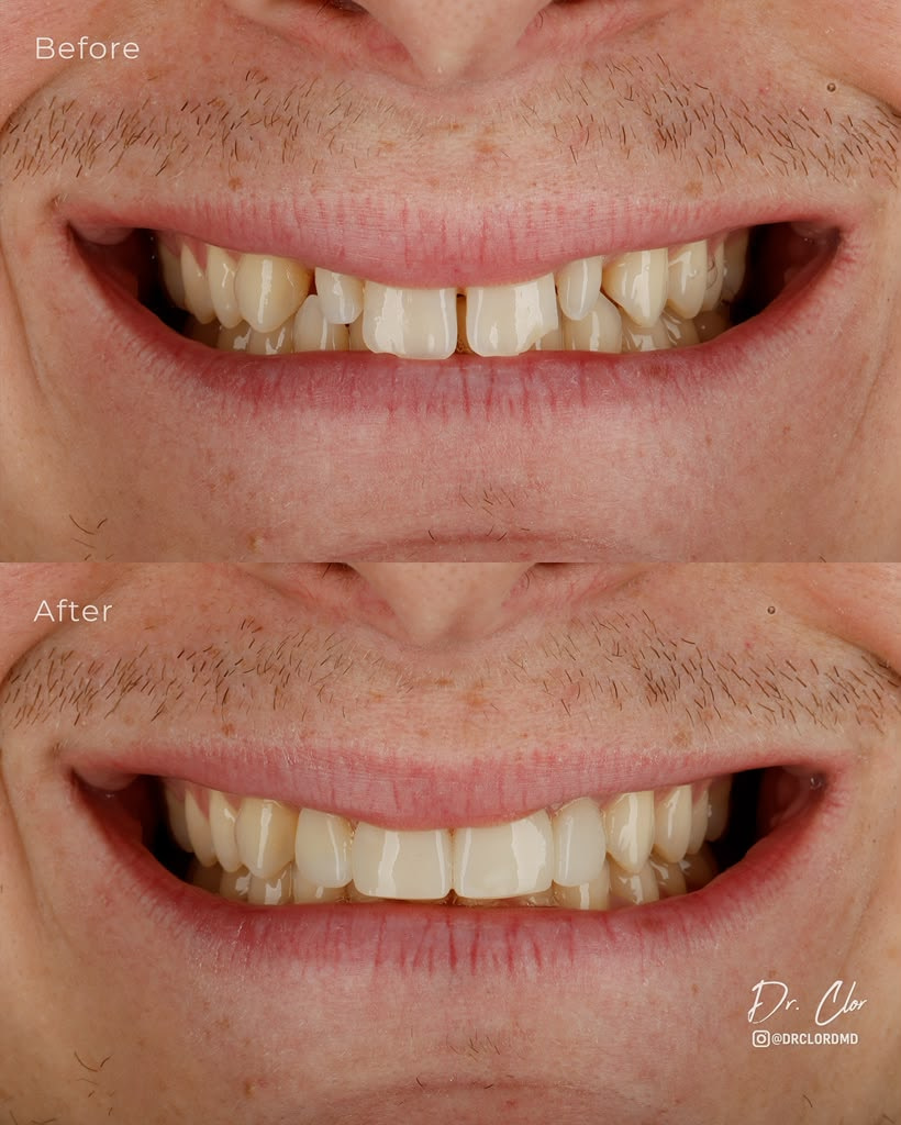 omar_clor_printed_restorations_dentistry (3)