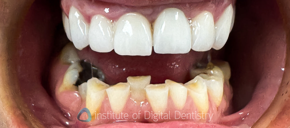 zirconia_worn_teeth_opposing_mandivular_anterior_wear_iDD