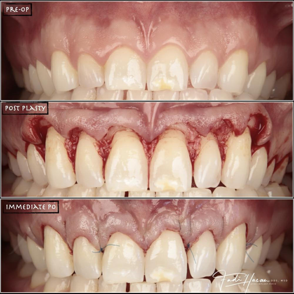 pre-op-post-plasty-fadi-hasan pre-op-post-plasty-fadi-hasan