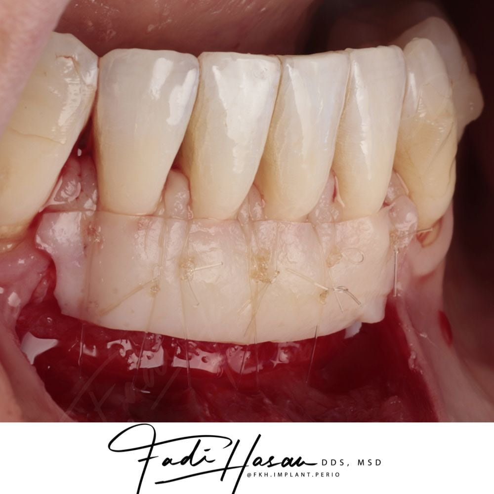 fadi-hasan-soft-tissue fadi-hasan-gingival-soft-tissue